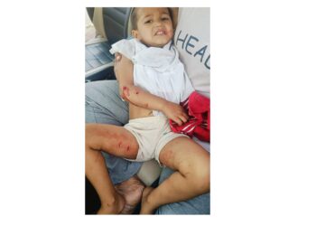घर के बाहर खेलते समय मासूम पर कुत्तो ने किया हमला, मासूम हुआ जख्मी